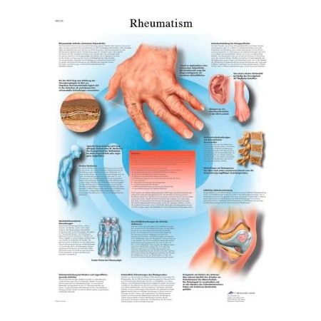 3BÂ Anatomical Chart - Rheumatic Diseases, Paper